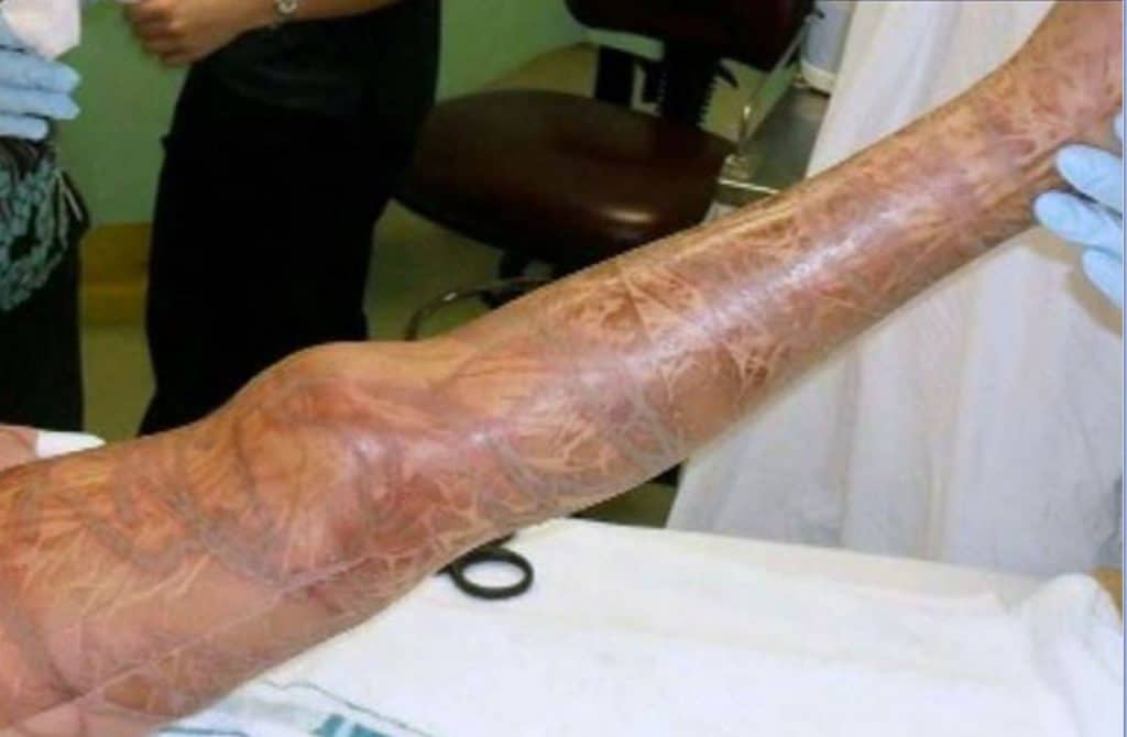 Female leg after box jellyfish sting toxins